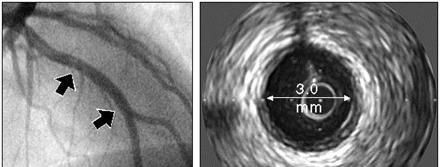 The IVUS technique can detect angiographically silent