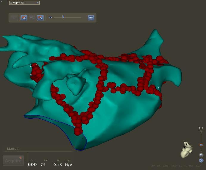 remodelling: a study with 3D strain Maria Agelaki, Julia Grapsa, David Dawson, Costas Papadopoulos, Petros Nihoyannopoulos,