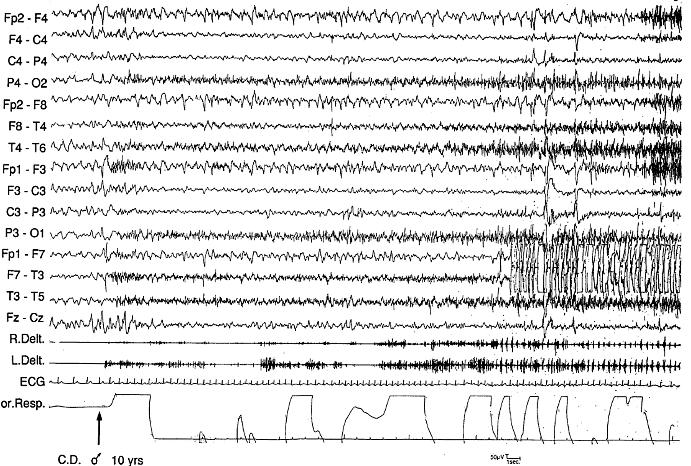 The seizure is characterized byviolent and complex ambulatory activity (2 min and 50 s) Polysomnographs: after a spike andwave complex coinciding with arousal, a small amplitude fast activity