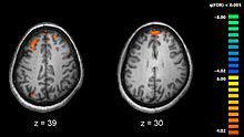 Η λειτουργική μαγνητική τομογραφία (fmri), και άλλες τεχνολογίες απεικόνισης του εγκεφάλου, επιτρέπει τη μελέτη των διαφορών στην εγκεφαλική δραστηριότητα σε άτομα που διαγνώστηκαν με σχιζοφρένεια.