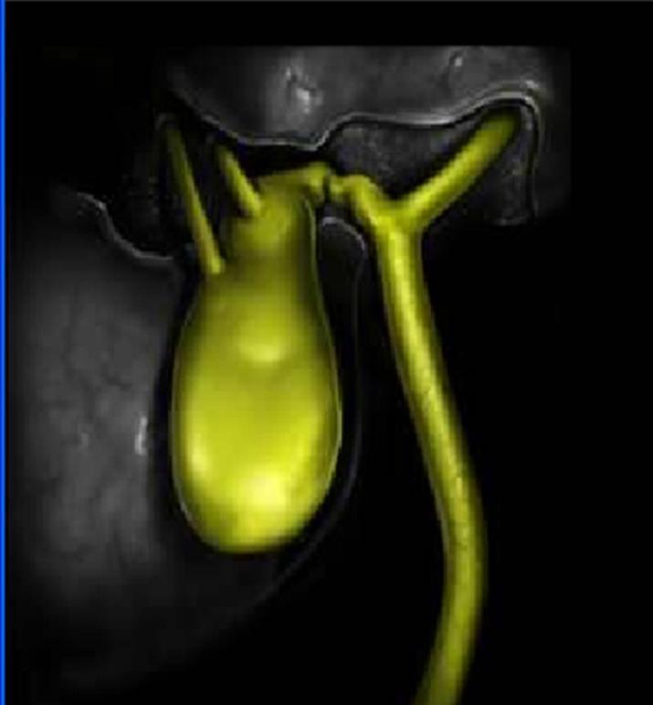 Type C Biliary leak from duct, not