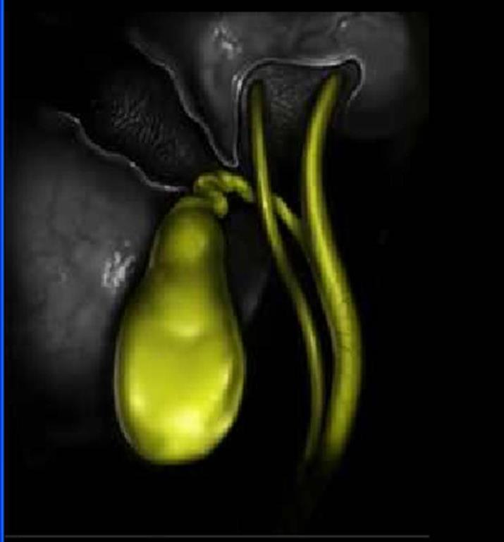 ductal system Aberrant duct