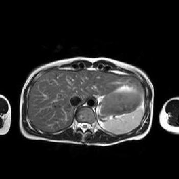 MRI η πιο ευαίσθητη και ειδική μέθοδος διάγνωση σε