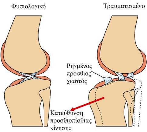 δύναμης στο σημείο έκφυσης του γαστροκνημίου μυός, δηλαδή στην οπίσθια επιφάνεια των μηριαίων κονδύλων.