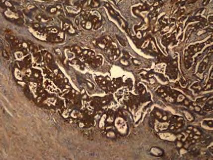Εικόνα 36: Εντονη έκφραση της CD54 στο στρώμα και επιθήλιο του όγκου Πίνακας 5.