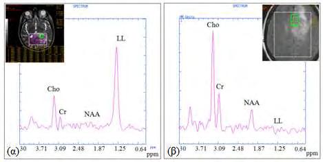 Εικόνα 7.2.3: Ενδεικτικά φάσματα υψηλού ΤΕ (144msec) δύο ασθενών, 54 ετών και 47 ετών, με πολύμορφο γλοιοβλάστωμα (α) και αναπλαστικό ολιγοαστροκύττωμα (β) αντίστοιχα.