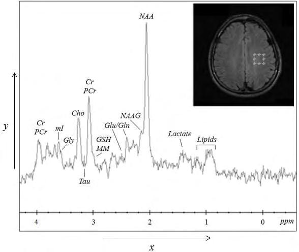 1.2 Φασματοσκοπία Πρωτονίου Μαγνητικού Συντονισμού (ΦΠΜΣ) Η διαφορά ανάμεσα στην απεικόνιση MRI και στην ΦΠΜΣ εντοπίζεται στο γεγονός ότι στην απεικόνιση, το λαμβανόμενο σήμα ραδιοσυχνοτήτων περιέχει