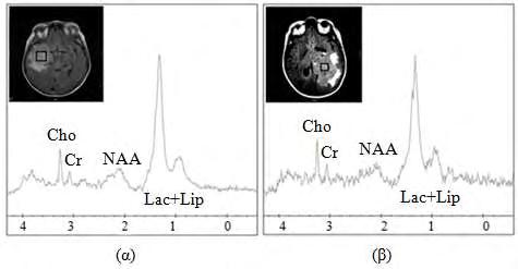 Εικόνα 2.1.3: Τυπικά φάσματα χαμηλού χρόνου ΤΕ ενός γλοιοβλαστώματος (α) και μιας εγκεφαλικής μετάστασης (β).