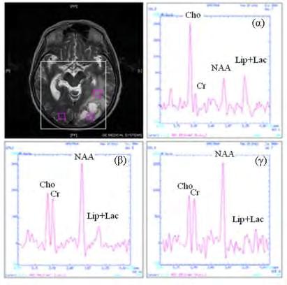 Εικόνα 6.1.2: Ενδεικτικά φάσματα από τις 3 περιοχές ενδιαφέροντος -κεντρικά (α), στην περιφέρεια (β) και αντιδιαμετρικά της εξεργασίας (γ)- σε ασθενή με ενδοκρανιακή μετάσταση.