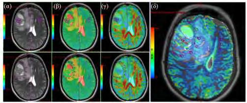 Εικόνα 6.1.3: Παραμετρικοί χάρτες ADC (β), FA (γ) και rcbv (δ). Μετρήσεις της διάχυσης (β, γ) και της αιμάτωσης (δ) στις 3 περιοχές ενδιαφέροντος.