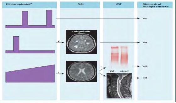 Πίνακας 5: Κριτήρια για τη διάγνωση της ΣκΠ. Lancet 2008; 372: 1502 17 Παρόμοια κλινική εικόνα με την ΣκΠ έχουμε και σε άλλα νοσήματα.