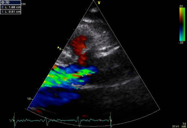 Jet width /LVOT diameter >40% Severe AR