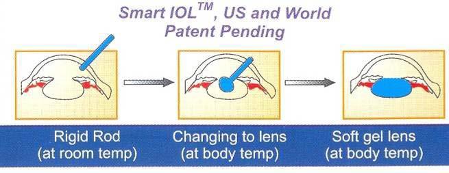 Eικόνα 17: ( Ένθεση Smart IOL πηγή - www.ioltech.com ) 8.4 Πειραματικές σχεδιάσεις ενδοφακών Ρυθμιζόμενος με φως ενδοφακός (Light adjustable lens).