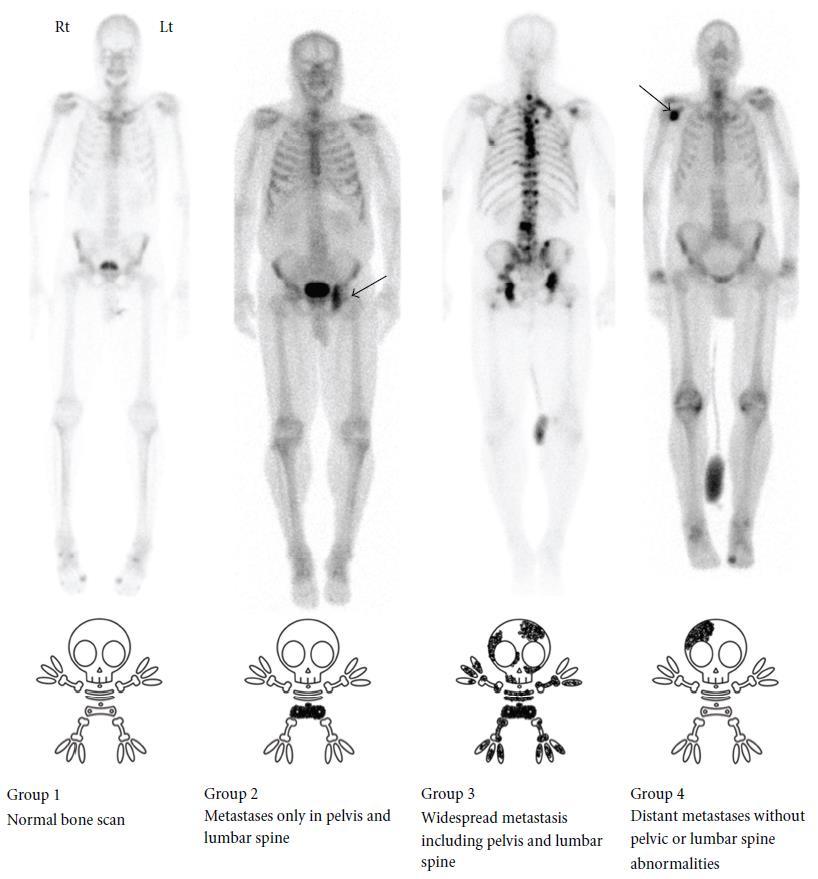 Το σπινθηρογράφημα οστών κατά τη διάγνωση 1201 bone scans (2000-2010) Σύγκριση με κλινικές παραμέτρους και CT ή MRI κοιλίας-πυέλου Στο νέο-διαγνωσμένο καρκίνο, εφόσον δεν υπήρχε εύρημα