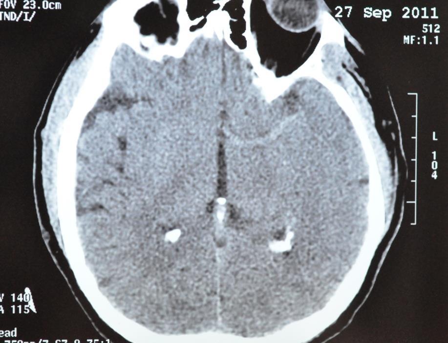 60 yo men, past MI, Paroxysmal AF presented <2