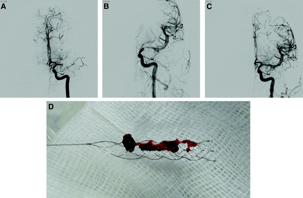 Basal angiogram with occlusion of middle cerebral artery