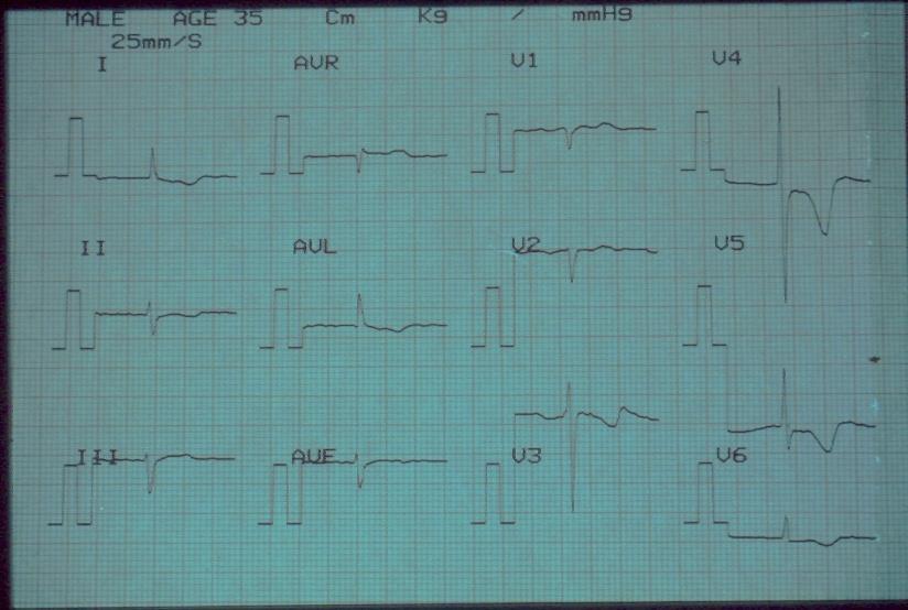 symptom onset is recommended in patients up to 60 years