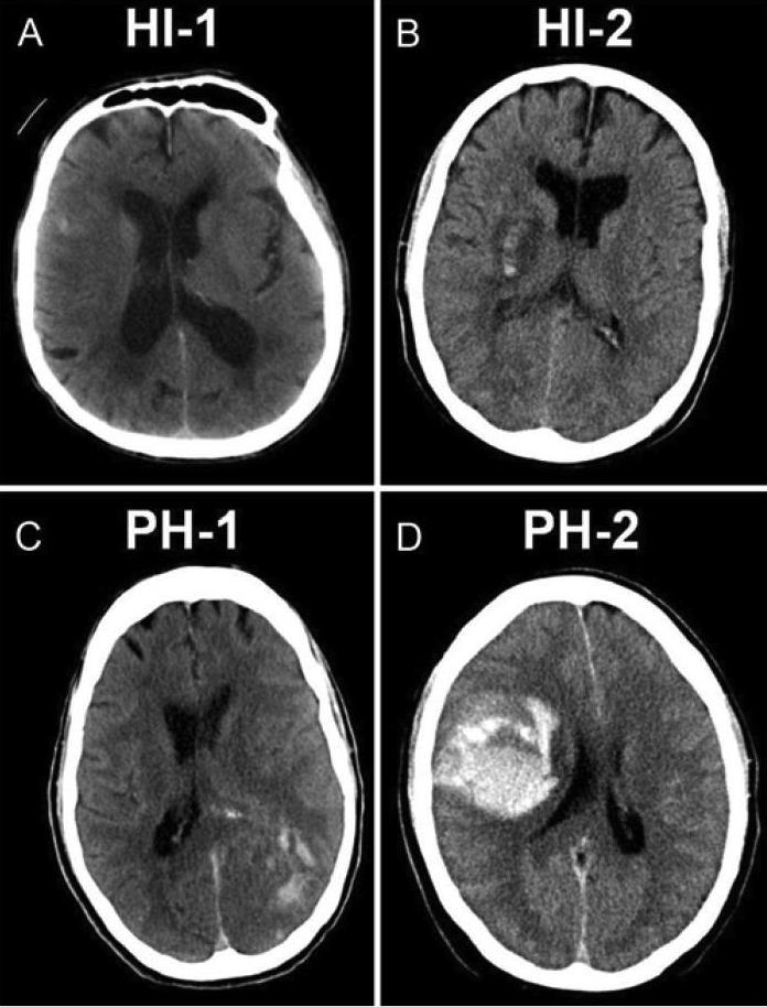 Subtypes of haemorrhagic transformation 53% 38% ECASS classification
