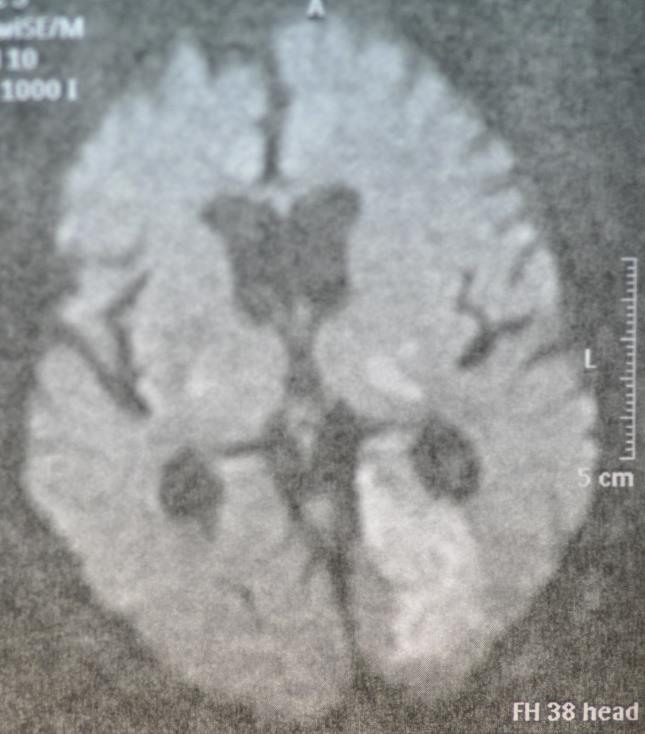 Case-1 Stroke and AF: 6 days restart