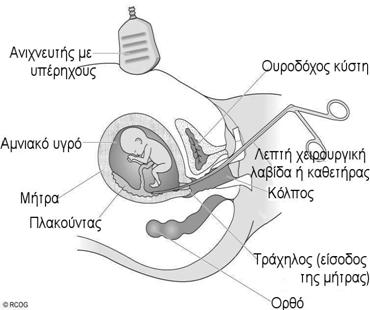 Τι είναι η λήψη χοριακής λάχνης (ή λήψη τροφοβλάστης); Η λήψη τροφοβλάστης είναι μια επεμβατική μέθοδος που ανιχνεύει χρωμοσωμικές και γενετικές ανωμαλίες.