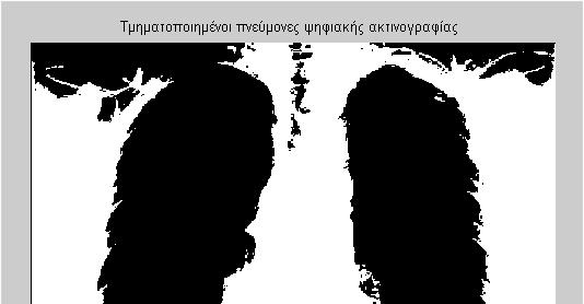 Ολική Κατωφλίωση