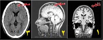 أصغر من عتبة محددة n X[n] = {(x,y) I(x,y) < n } (7) وبالتالي يمكن تشبيه المصبات في الصورة بالحفر التي يتم ملؤها بالتدريج, بحيث يزداد مستوى الماء كلما رفعنا قيمة العتبة حتى يحصل اتحاد بين المصبات