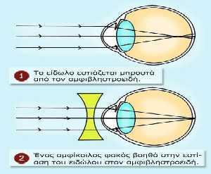 Μυωπία Μυωπία είναι η διαθλαστική ανωμαλία κατά την οποία παράλληλες ακτίνες φωτός εστιάζουν (σε απροσάρμοστο οφθαλμό) μπροστά από τον αμφιβληστροειδή (σχήμα2).