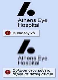 Σχήμα 3: Υπερμετρωπικός οφθαλμός (διαδίκτυο) Αστιγματισμός Αστιγματισμός είναι η διαθλαστική ανωμαλία, κατά την οποία παράλληλες ακτίνες φωτός δε διαθλώνται εξίσου σε όλους τους μεσημβρινούς.