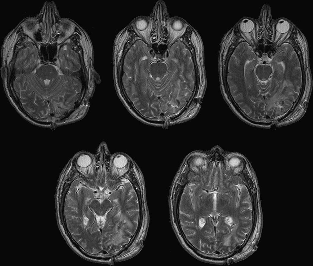 Οριηόντια διατομι T2 weighted MRI: βλάβθ ςτον ταινιωτό φλοιό (V1), ςτθ μζςθ ινιακι ζλικα, ςτο κάτω τμιμα