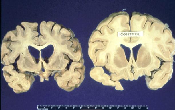Σε παθολογοανατομικά παρασκευάσματα παρατηρούμε ατροφία του εγκεφάλου με διεύρυνση των αυλακών και των κοιλιών.
