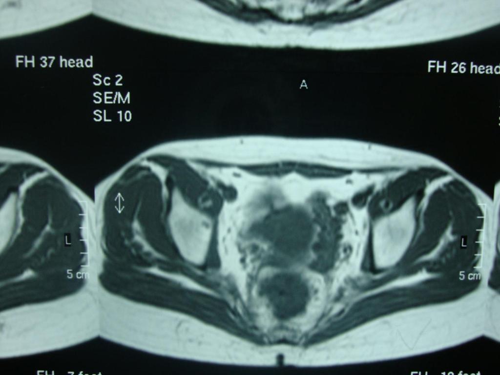 MRI ΜΕΤΑ ΤΘΝ