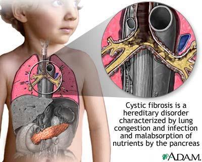 Παράδειγμα 2: Κυστική ίνωση (Cystic Fibrosis) Η κυστική ίνωση είναι μία πάθηση της λευκής φυλής που επιφέρει το θάνατο σε νεαρή ηλικία.
