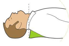 Χρήση του συστήματος παθητικής υποστήριξης αεραγωγού (PASS) Αν δεν υπάρχει ένδειξη τραυματισμού στο κεφάλι ή στον αυχένα, συνιστάται η κλίση του κεφαλιού με ταυτόχρονο ανασήκωμα του πηγουνιού για τη