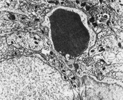 ίπλα στο αποπτωτικό αυτό κύτταρο ξεχωρίζει ο πυρήνας ενός «ζωντανού» νευρώνα (Ν).