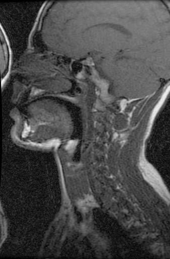 5: Απεικόνιση MRI της ϕωνητικής οδού : 4 από τις 16