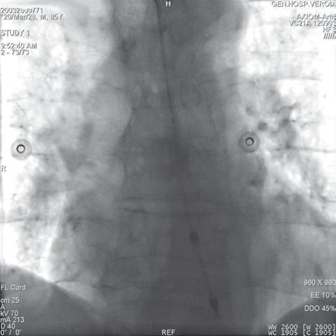 Αντιμετώπιση Ασθενών με Κολπικό Πτερυγισμό τύπου Ι: Έχει θέση η Οισοφαγική Βηματοδότηση; Εικόνα 2. Θέση του διοισοφάγειου ηλεκτροδίου. μα (κύμα Α).
