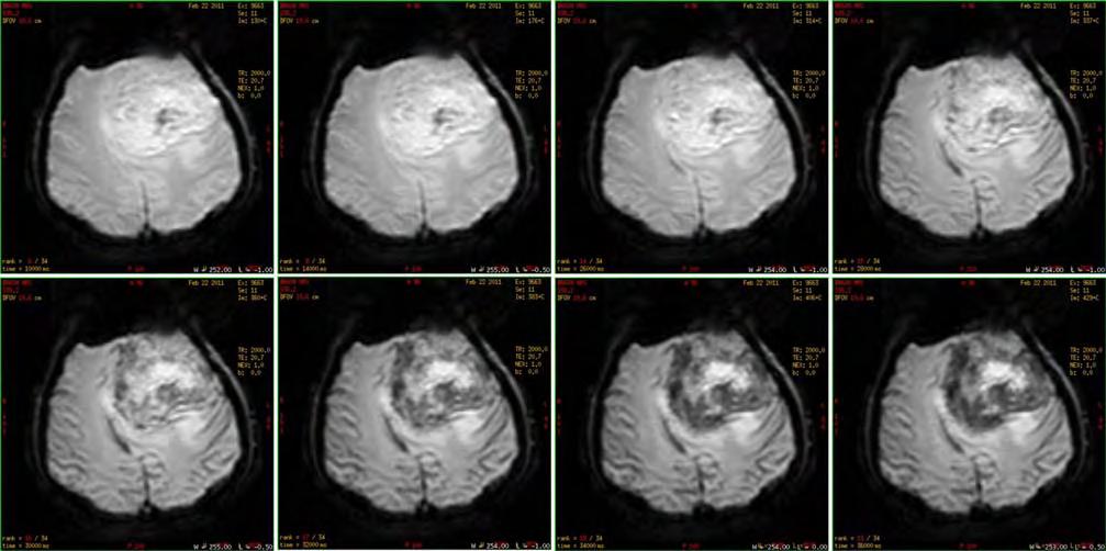 1.2.3 Δυναμική Απεικόνιση της Αιμάτωσης (Dynamic Susceptibility Contrast Imaging, DSCI) Ο όρος αιμάτωση αναφέρεται στην τροφοδοσία ενός ιστού με αίμα από τα τριχοειδή αγγεία και η απεικόνιση της
