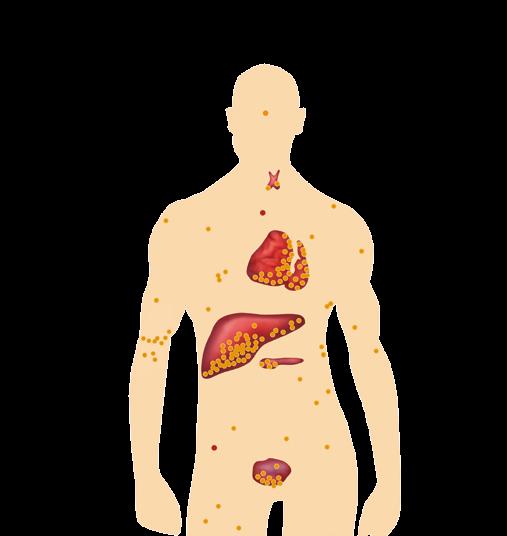 Τι μπορούμε να κάνουμε σε περίπτωση υπερσυγκέντρωσης σιδήρου; Συχνότερες βλάβες οργάνων από την αποθήκευση σιδήρου στην καρδιά, το ήπαρ και τους αδενικούς ιστούς.