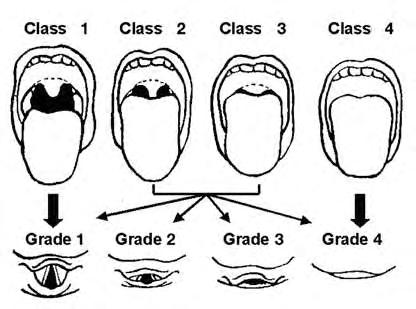 50 διαπιστώνεται η ύπαρξη ή μη θολωτής σκληρής ή επιμηκυμένης μαλθακής υπερώας, μεγάλης γλώσσας και ορθοδοντικών ανωμαλιών (κακή σύγκλειση δοντιών) εξαιτίας υποπλασίας ή οπίσθιας θέσης κάτω γνάθου.