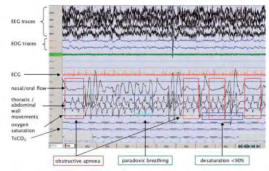 62 Εικόνα 4. Πολυκαταγραφική μελέτη παιδιού με σύνδρομο αποφρακτικών απνοιών στον ύπνο με συχνά επεισόδια αποκορεσμού και αποφρακτικών απνοιών.