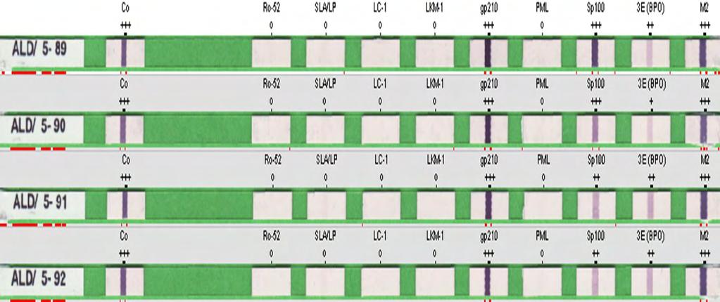 5.4.1.δ Line Immunoassay Η ύπαρξη ΙgG ΑΜΑ, αντι-sp100 και αντι-gp210 επιβεβαιώθηκε και με τη μέθοδο Line Immunoassay τόσο πριν όσο και μετά τη θεραπεία.