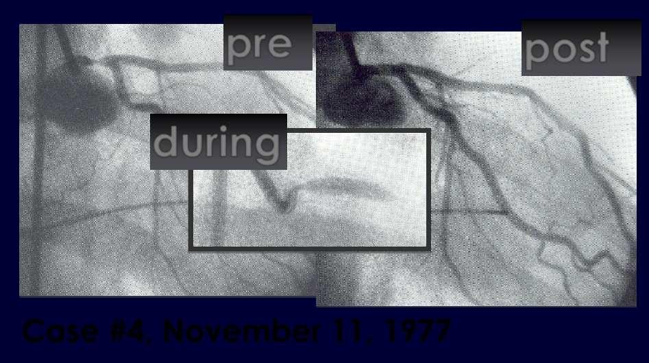 First attempts Balloon angioplasty for left main coronary
