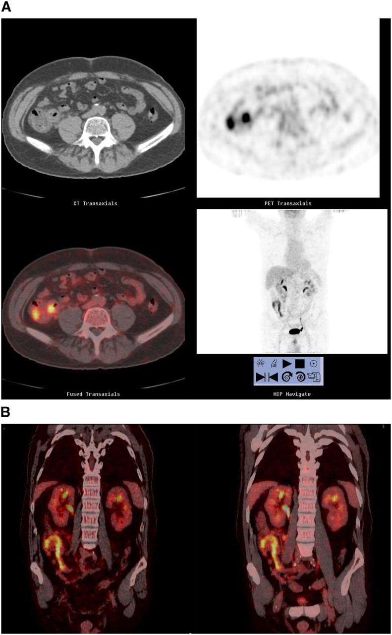 18F-FDG PET/CT u Kronovoj bolesti: transverzalni (A) i frontalni preseci (B) ukazuju na fokalno povećano