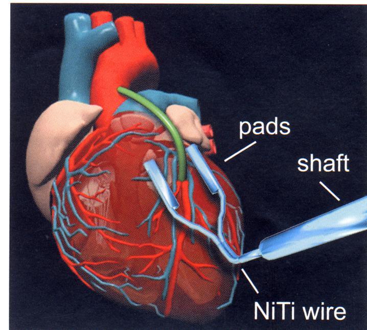 Ni-Ti stent