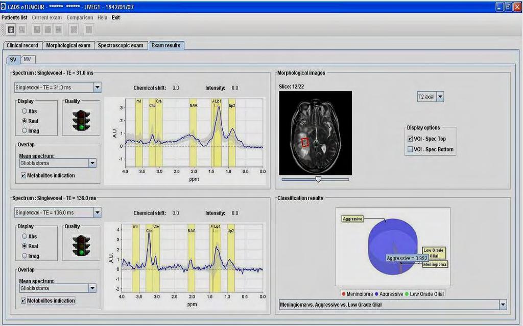Εικόνα 3.8 etumour CADS Γραφικό Περιβάλλον: Παράδειγμα ταξινόμησης ενός πολύμορφου γλοιοβλαστώματος [Celda B 2009].