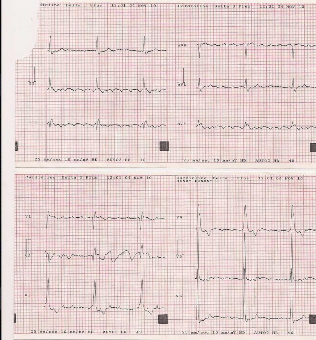 Lower Loop Reentry ECG: Lack of