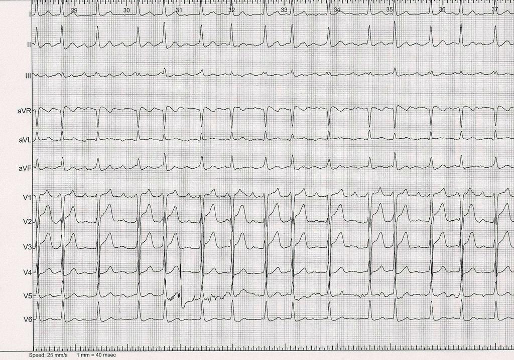 12-Lead 12-lead ECG A 68-year-old man with previous Circumferential Pulmonary Vein Ablation