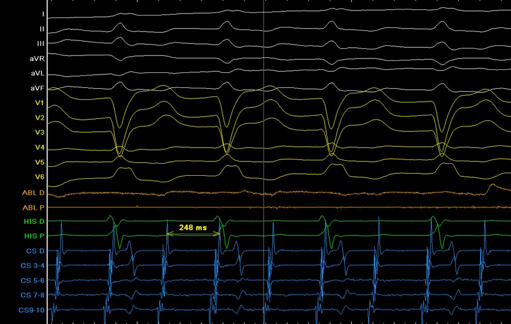 Organization to stable tachycardia with proximal to distal CS