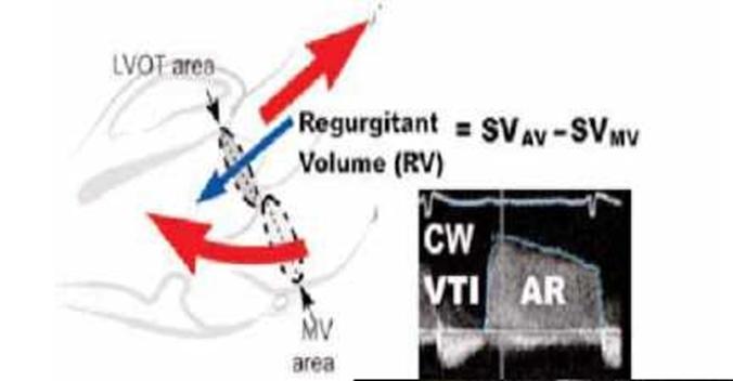 Volumetric method Reg Vol=SV AV SV MV SV= 2πr 2 x VTI=0.