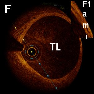 F: Normal distal to the dissection